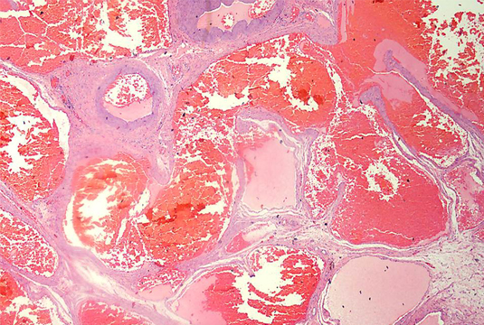Case of ovarian cavernous hemangioma