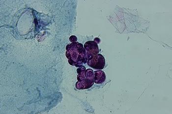 Intraductal Papillary Lesions: A Clinical Case Study