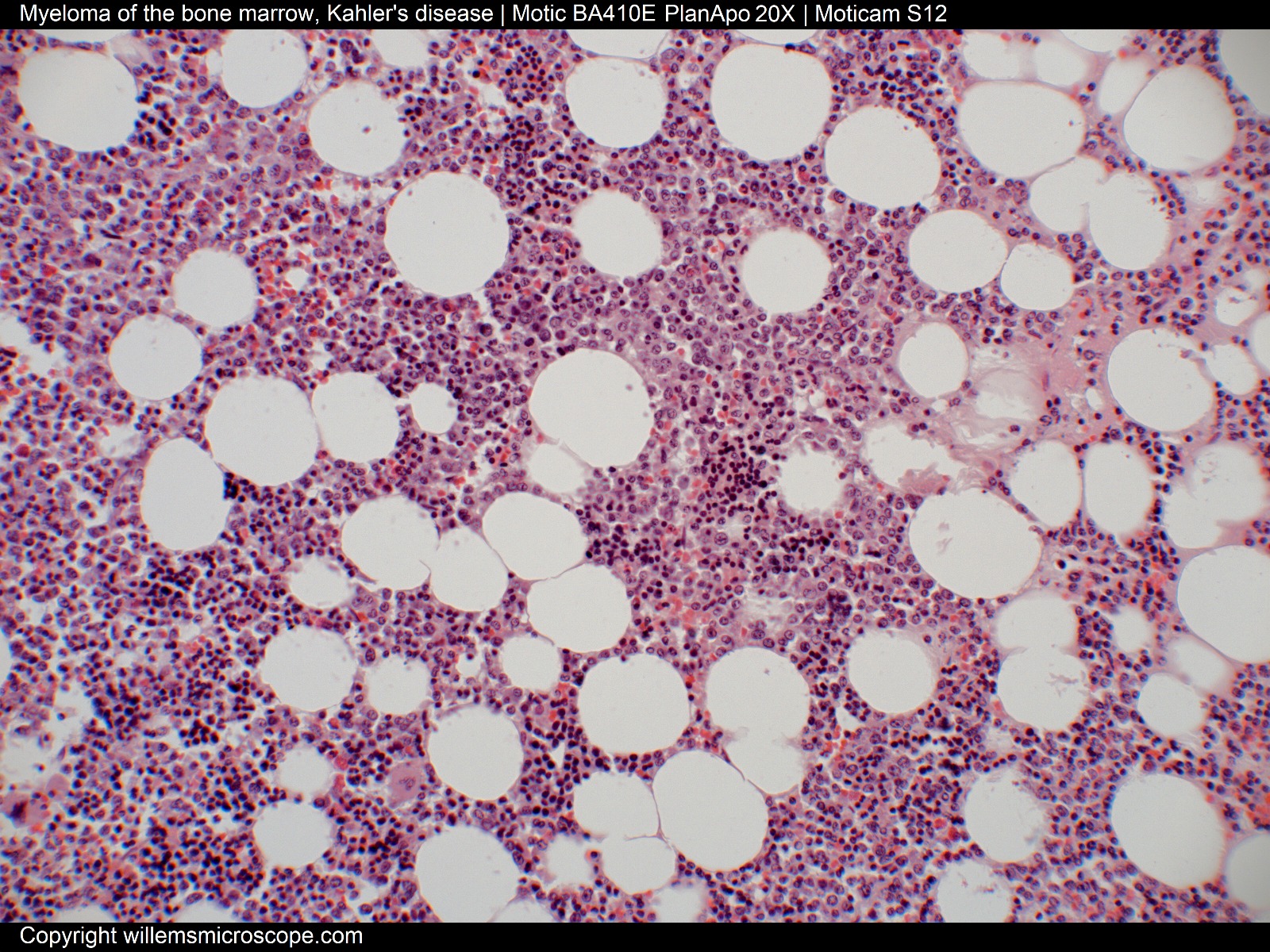 Myeloma of the bone marrow.