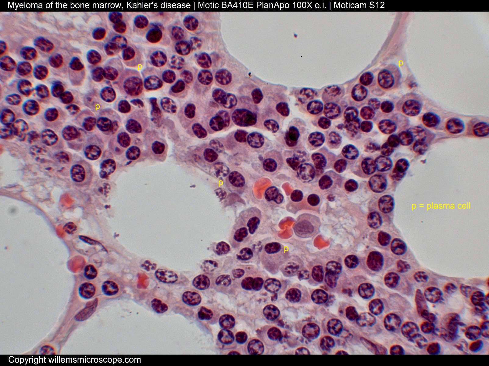 Myeloma of the bone marrow.